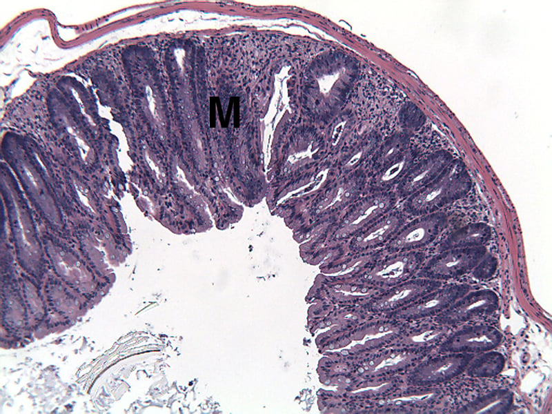 ACD5MAUC-Diseased-Distal-Colon