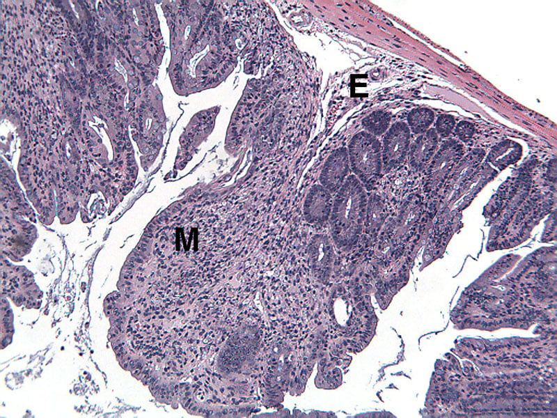 ACD6MAUC-Diseased-Proximal-Colon